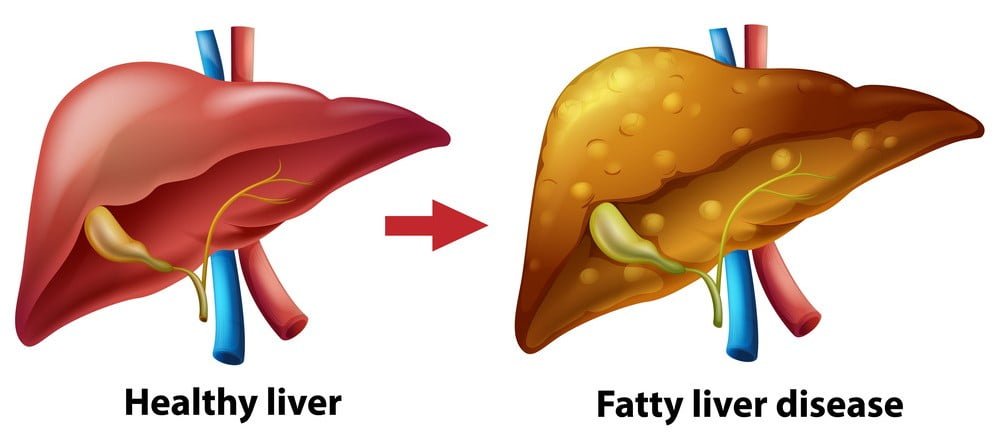 Ayur Raksha - fatty liver