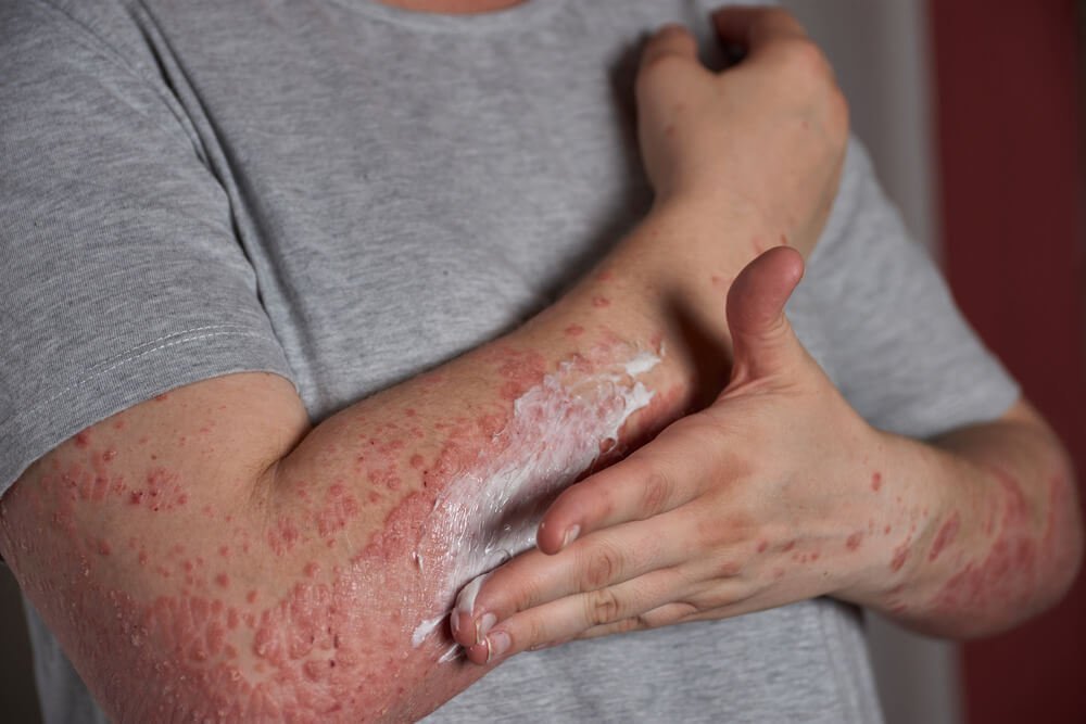 Ayur Raksha - person with psoriasis