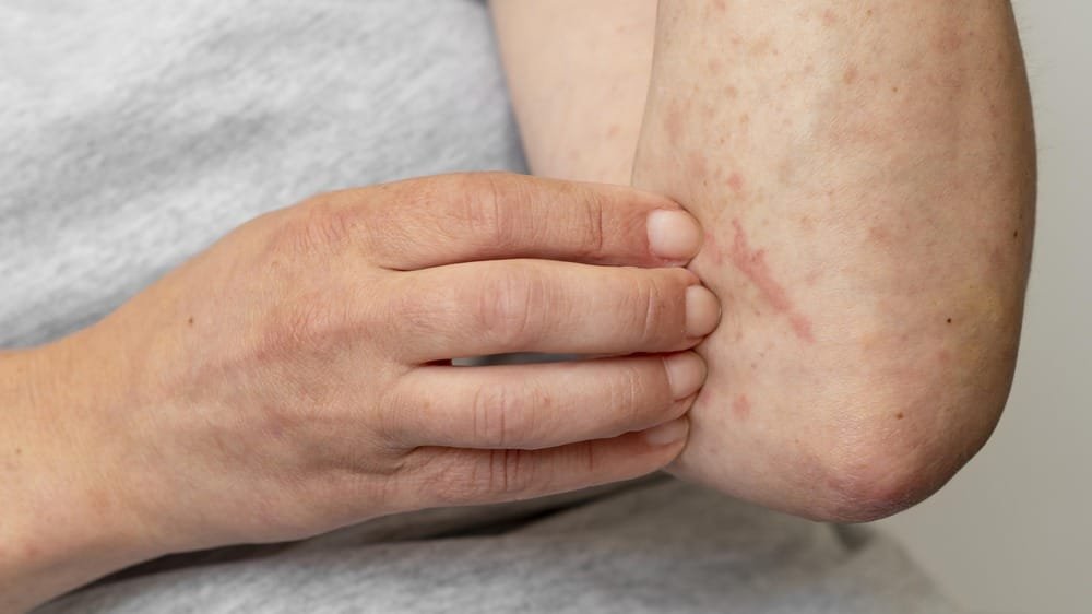 Ayur Raksha - permanent cure for psoriasis in Ayurveda permanent cure for psoriasis in Ayurveda