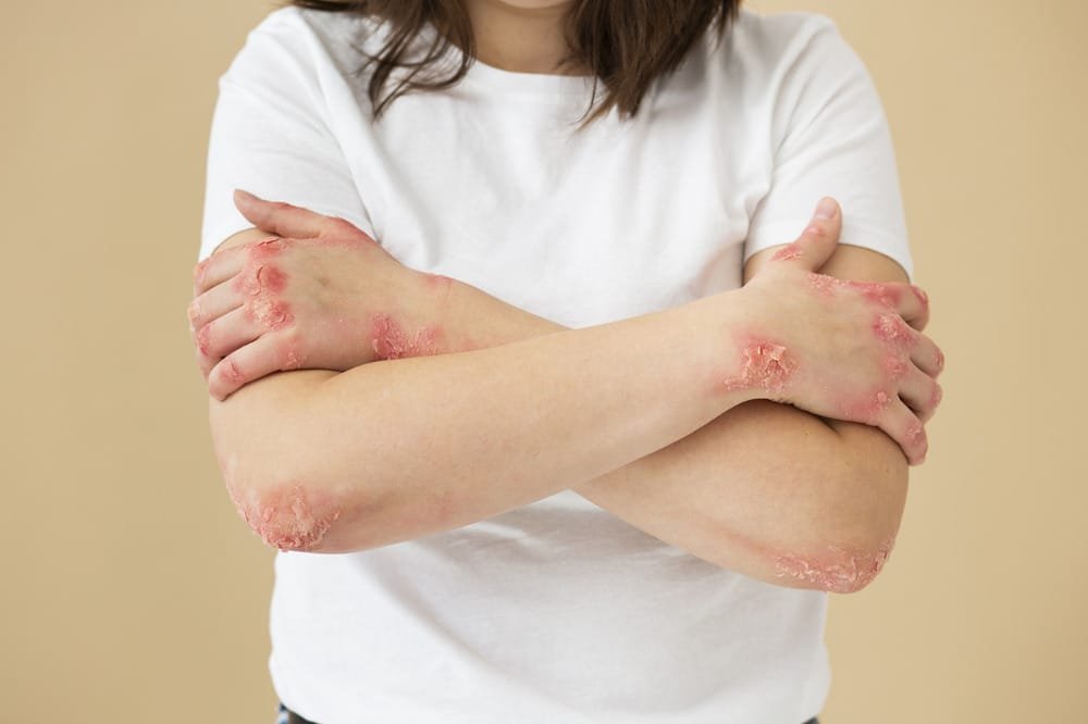 Ayur Raksha - Psoriasis treatment without steroids psoriasis treatment without steroids