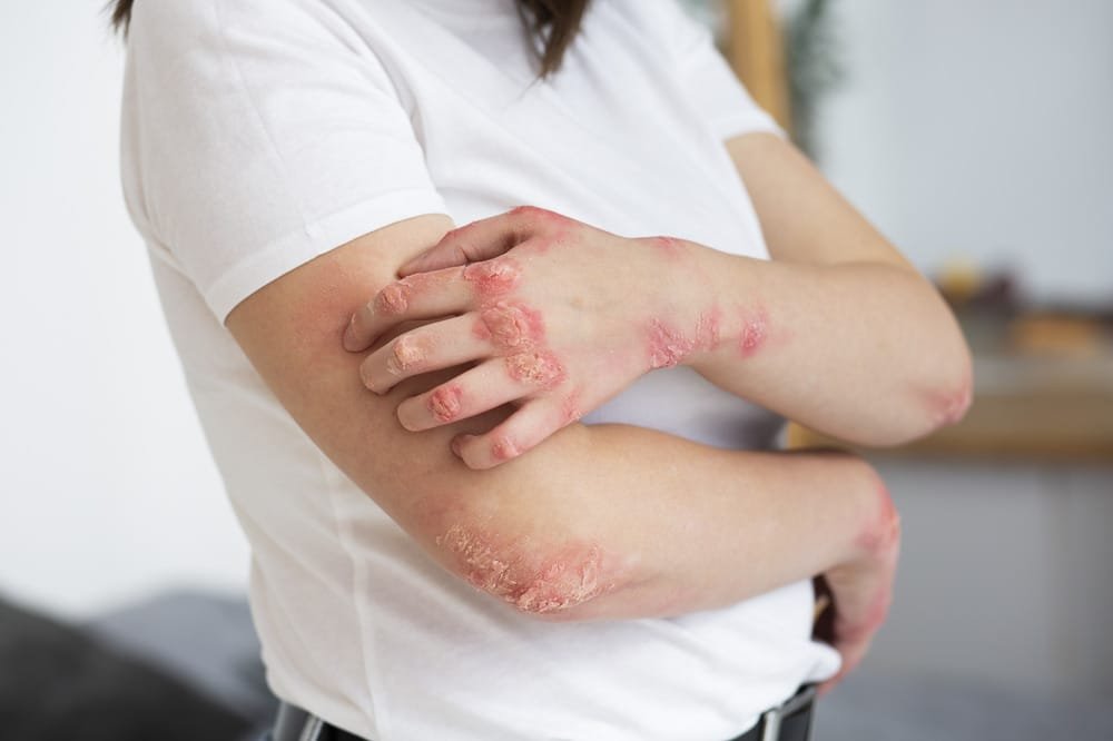 Ayur Raksha - Ayurvedic skin care for psoriasis Ayurvedic Skin Care for Psoriasis