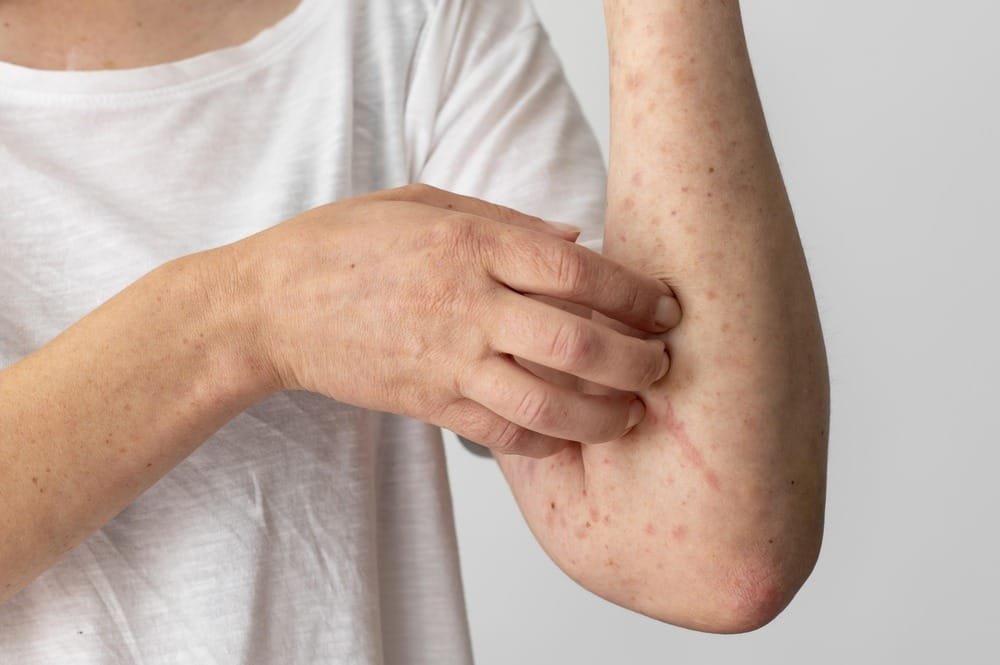 Ayur Raksha - Best treatment for psoriasis in Ayurveda best treatment for psoriasis in Ayurveda