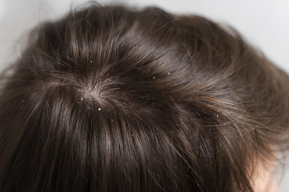 Ayur Raksha - Scalp psoriasis natural treatment scalp psoriasis natural treatment